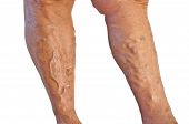 picture of vein  - Two tanned legs with varicose veins on white background - JPG 