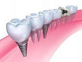 stock photo of embed  - Dental implants in the gum  - JPG 