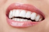 pic of silicon  - teeth with whitening tray - JPG 